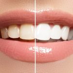 Types of Teeth Stains and How to Get Rid of Them