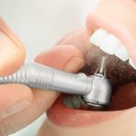 What are the most popular dental restoration methods? Get to know here!