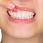 How to Know You Have Gum Disease in Uptown Phoenix, AZ, and How to Prevent It