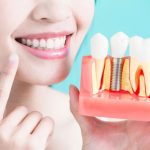 How Do I Handle The Pain After Dental Implants? 