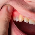 Tooth Abscess: Most Common Symptoms