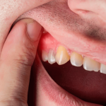 Gum Disease –Causes, Symptoms, Treatment 